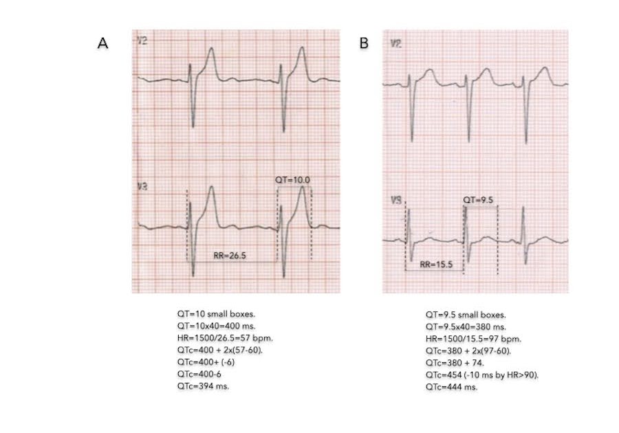 Qtc норма экг у взрослых. Интервал qtc на экг норма таблица. Qtc норма экг у взрослых. Pq qrs qt норма. Интервал qt на экг норма таблица.