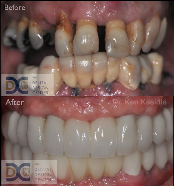 dental%2Bmakeover%2Bimplant%2Bpattaya