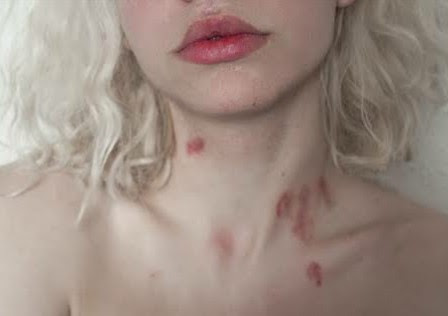 Menghilangkan Bekas Cupang Di Leher