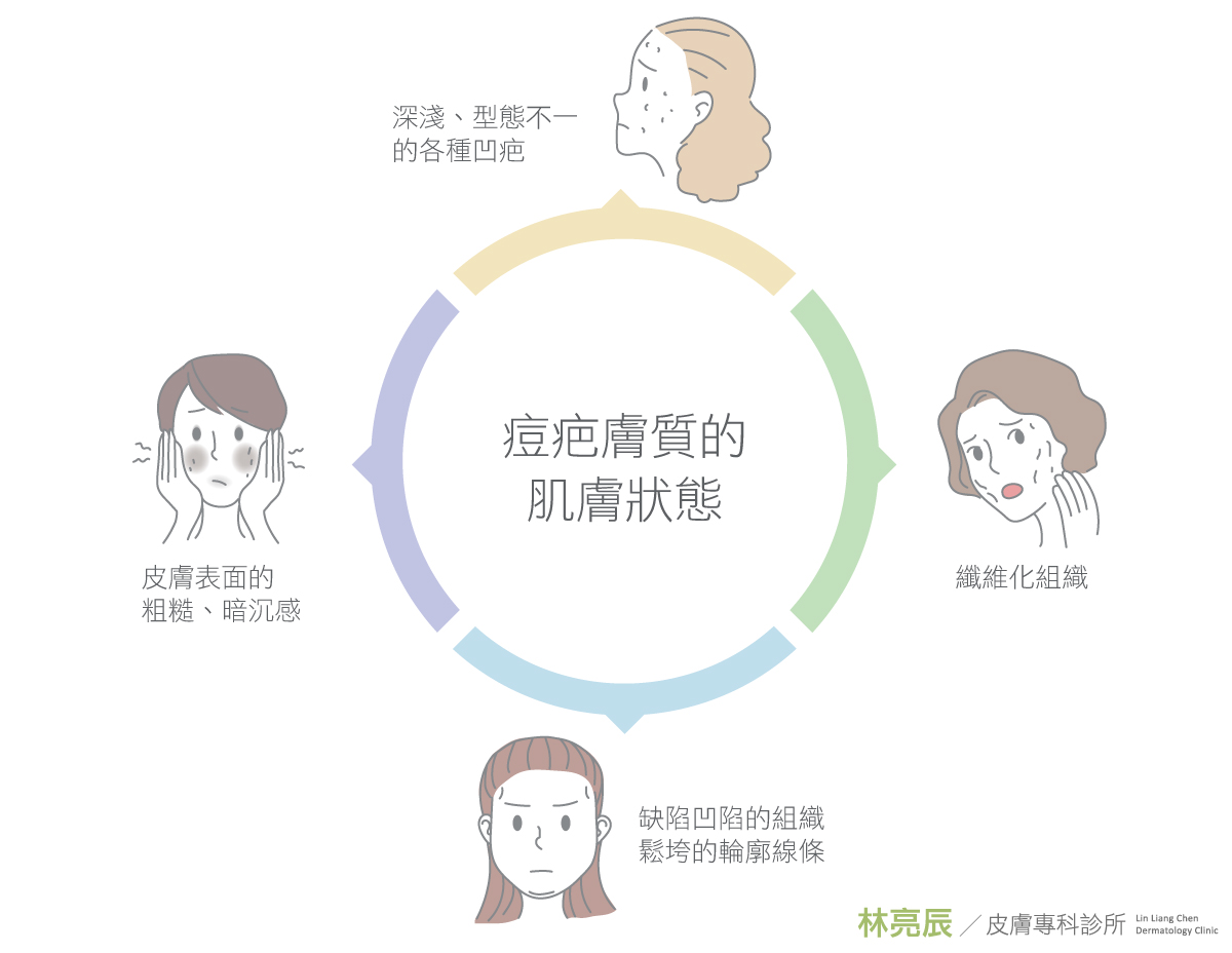 PicoSure755皮秒雷射蜂巢式聚焦陣列透鏡蜂巢皮秒雷射雀斑痘疤毛孔細紋新竹推薦林亮辰皮膚專科診所林亮辰醫師UP雷射UltraPulse痘疤凹疤痘疤淡化凹疤修復凹疤ptt凹洞治療費用