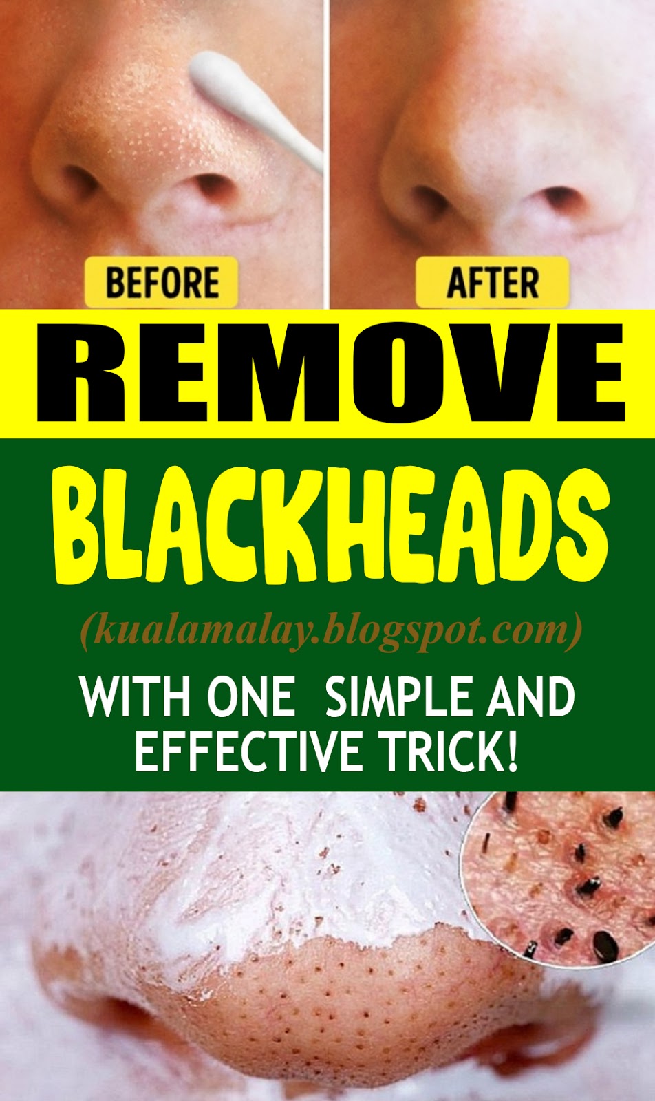 REMOVE BLACKHEADS WITH ONE SIMPLE AND EFFECTIVE TRICK