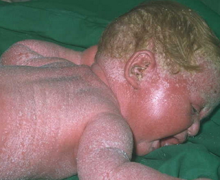 Titik refleksi untuk mengatasi Leiner pada bayi Titik refleksi untuk mengatasi Leiner pada bayi