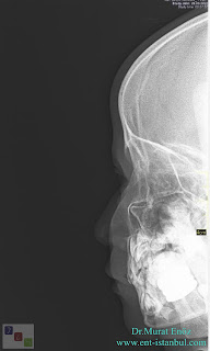 Nasal trauma and fractures in children