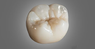 Why Zirconium crowns are replacing Porcelain fused to metal crowns?