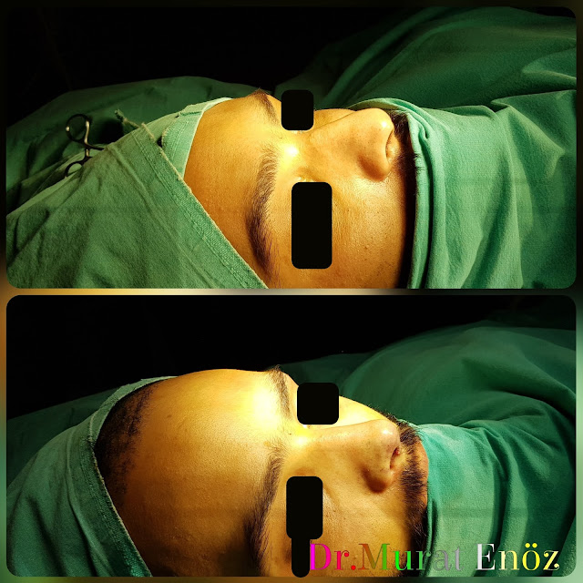 Nose Tip Plasty, Nose Tip Lifting,droopy nose tip,