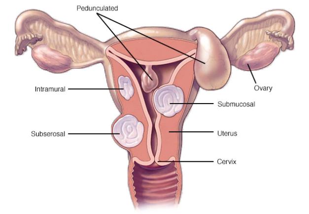 types of uterine fibroids uterus facts