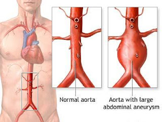 Medical Encyclopedia: Abdominal Aorta Aneurysm