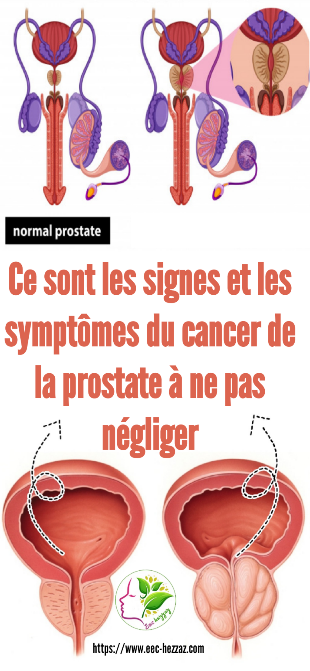 Ce sont les signes et les symptômes du cancer de la prostate à ne pas négligerCe sont les signes et les symptômes du cancer de la prostate à ne pas négliger