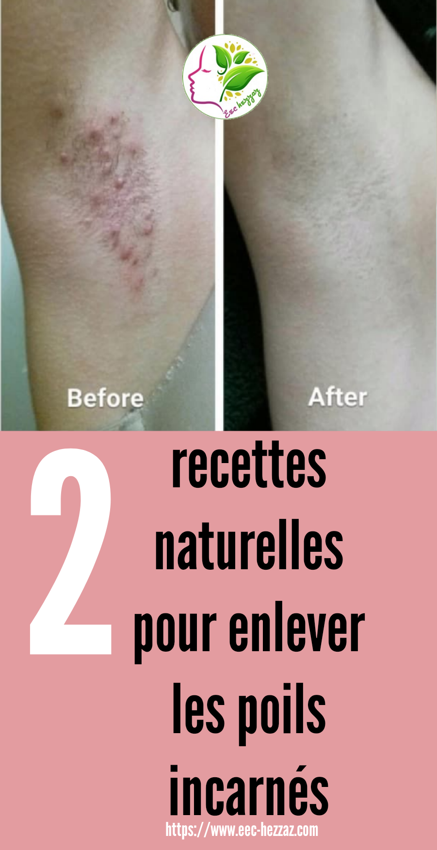 2 recettes naturelles pour enlever les poils incarnés