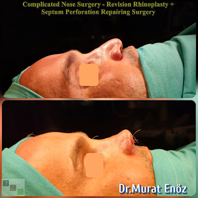Complicated rhinoplasty + nasal septum perforation closure surgery