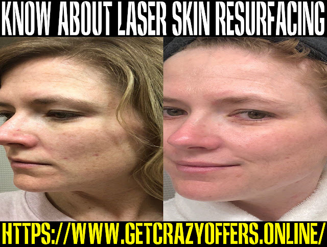 Is Laser skin resurfacing safe? Is Laser skin resurfacing safe?