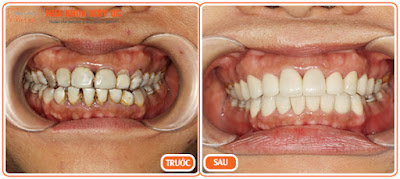 Top 3 vấn đề bạn cần biết trước khi bọc răng sứ B%25E1%25BB%2587nh%2Bnh%25C3%25A2n%2Bbrs