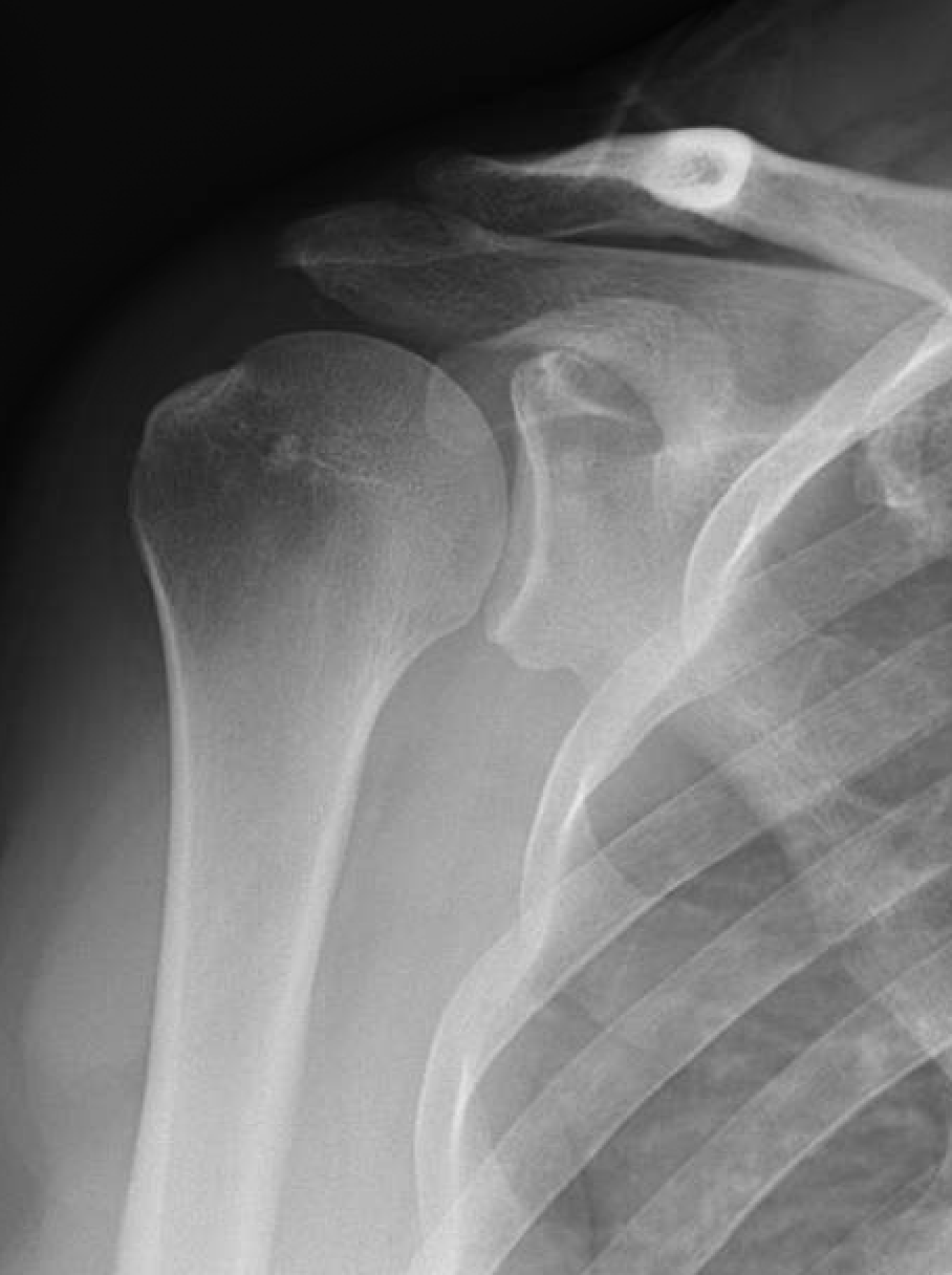 Shoulder and Elbow Surgery Margin Convergence successful rotator