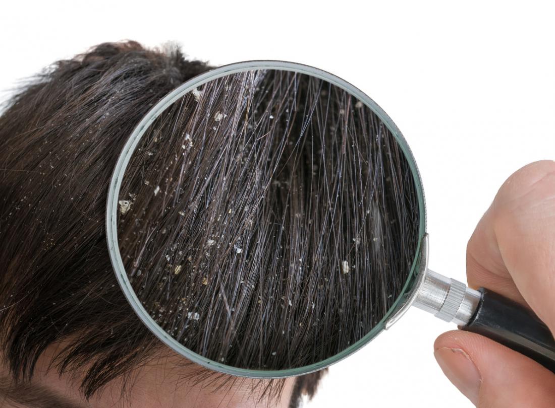 How to remove Dandruff Permanently Health and Fitness