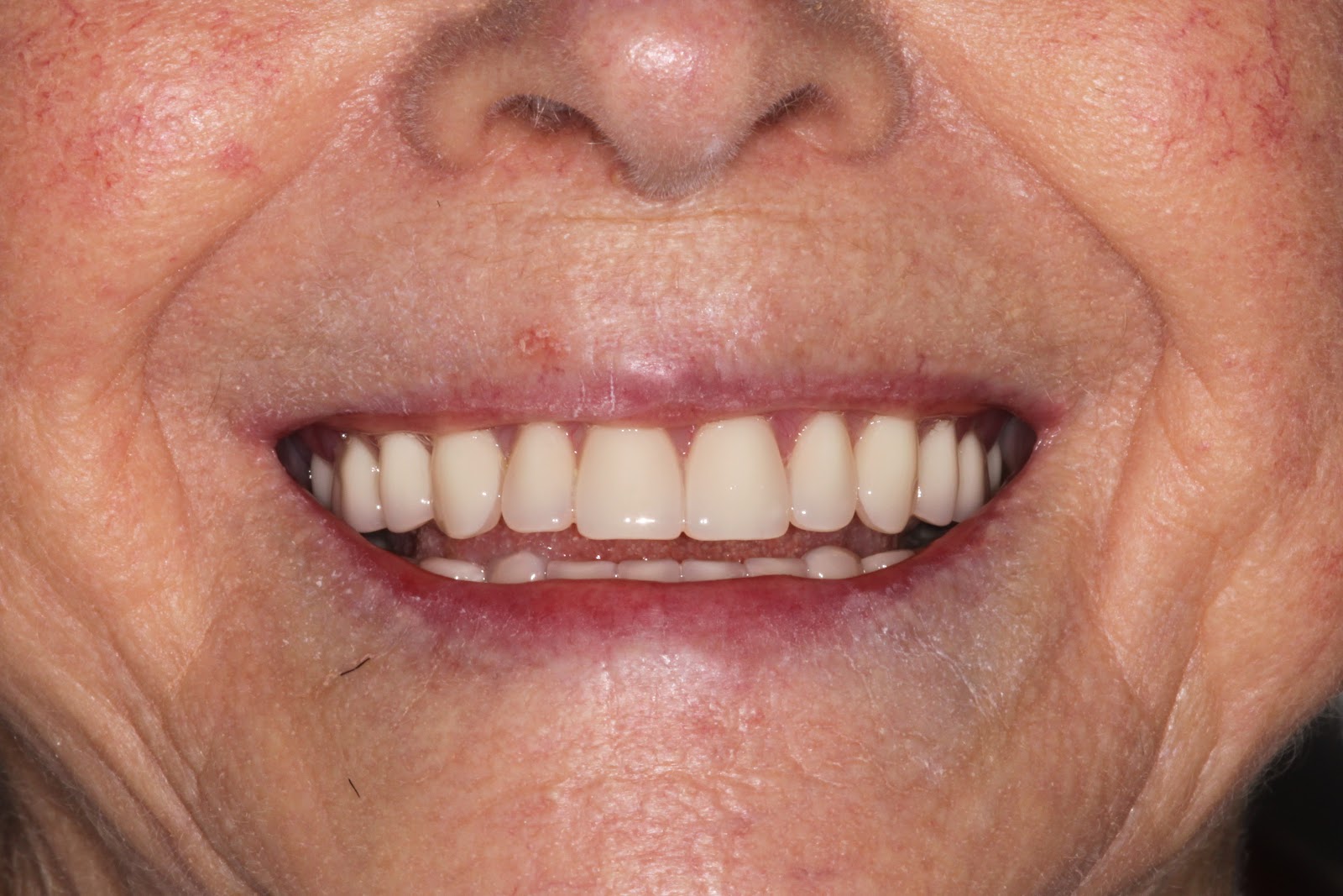 Boise Idaho Prosthodontics Maxillary Complete Denture / Mandibular Complete Denture