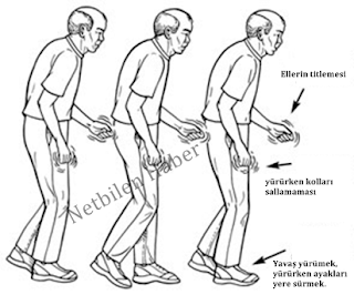 Parkinson Hastalığı Tedavisi