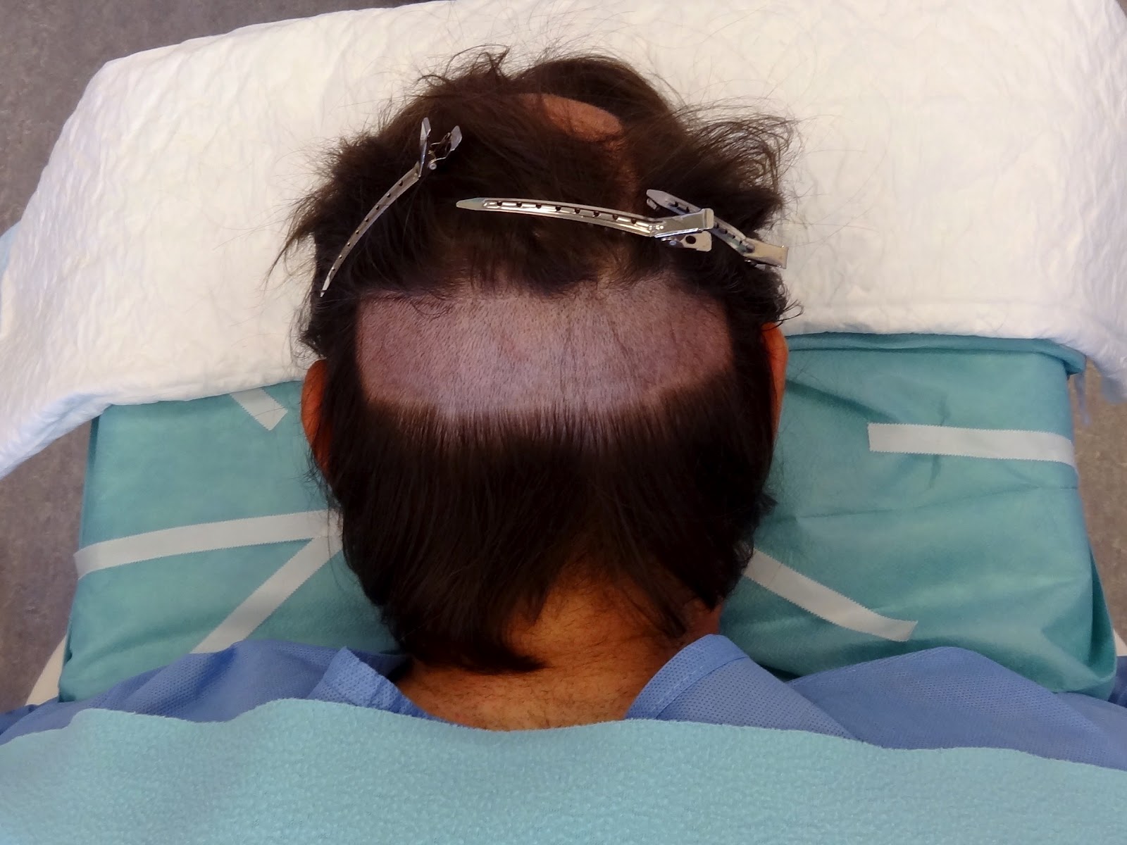 To Shave or Not to shave for an FUE hair transplantation