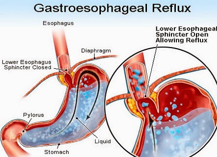  cure Gastroesophageal Reflux Disease (GERD)? | Minds Building