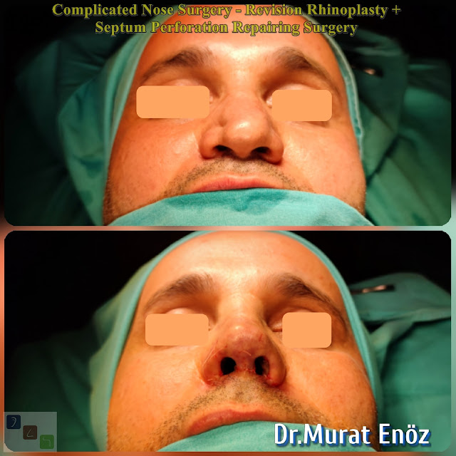 Complicated rhinoplasty, nasal septum perforation closore surgery,2nd Revision Male Rhinoplasty,Closure of nasal septum perforation with rib cartilage,