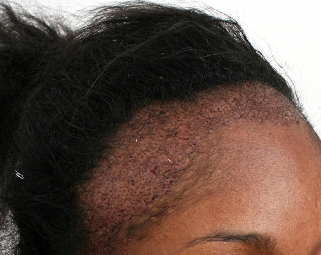 Styles With Personality Hair Care Tips What Is Retraction Alopecia And How Do You Get It