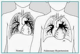 Medical Treatment Pictures-for Better Understanding: Pulmonary Hypertension