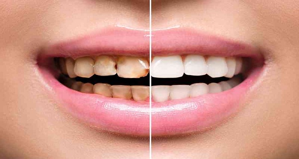 tartar breaking off back of teeth tartar breaking off back of teeth