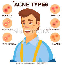 Understanding The Different Types Of Acne.