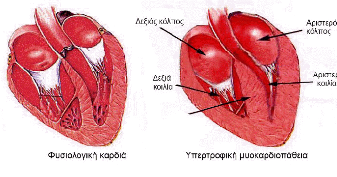 Изменения миокарда левого желудочка сердца. 2. Гипертрофия правого желудочка:. Миокард правого желудочка. Гипертрофия левого желудочка сердца.