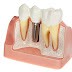 Trồng răng implant trong trường hợp nào?