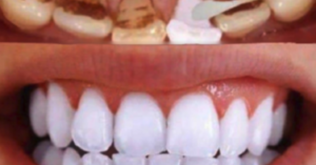 Porque La Pasta Dental Es Una Mezcla SOLO USA ESTOS 2 INGREDIENTE ELIMINAR EL SARRO DE LOS DIENTES DESPUÉS