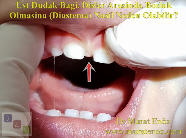 Üst Dudak Bağları Dişlerde Ayrılma (Diastema) ve Diş Çürümesine Nasıl