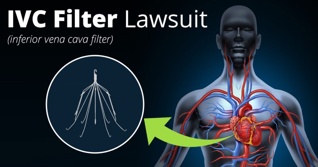 IVC Filter Settlements