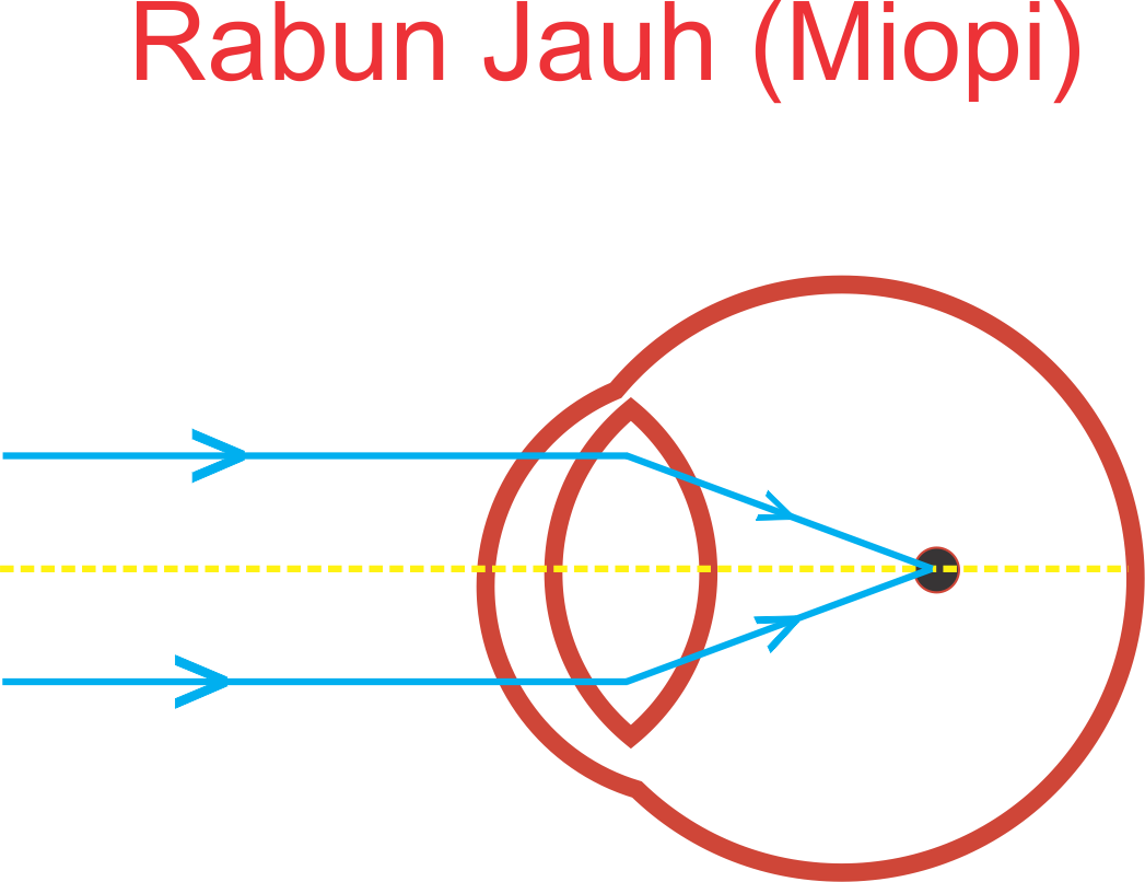 miopie 8 dioptrii