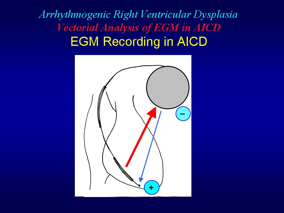 ARVCsGF: Vectorial interpretation of VT/SVT signals stored in the ICD