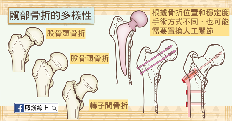 治療 頸 骨折 骨 大腿 部 大腿骨頸部、転子部骨折 理学療法（治療・前編）