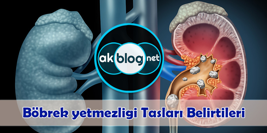 Böbrek yetmezliği Böbrek Taşları Belirtileri