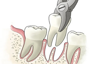 Procédure d'extraction des dents