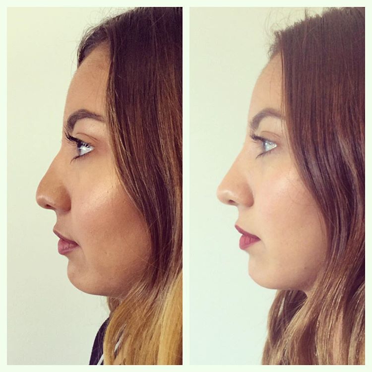 Best Nose Fillers (Non Surgical Nose Job) Singapore Price and Reviews 2023