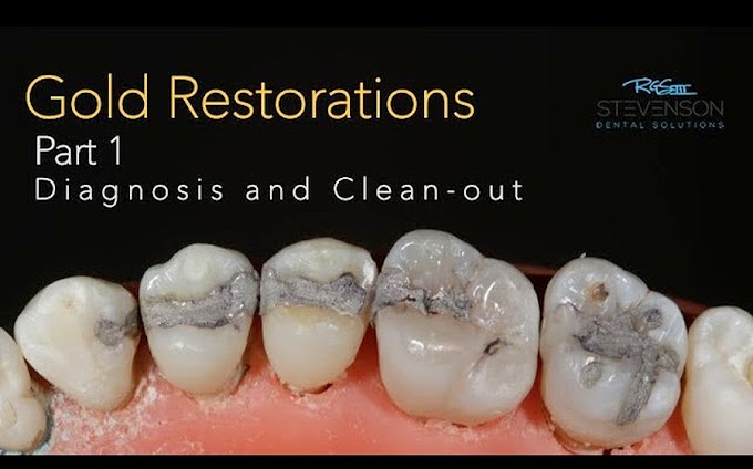 CAST GOLD Restorations - PART 1: DIAGNOSIS and CLEAN-OUT - Dr. Richard Stevenson