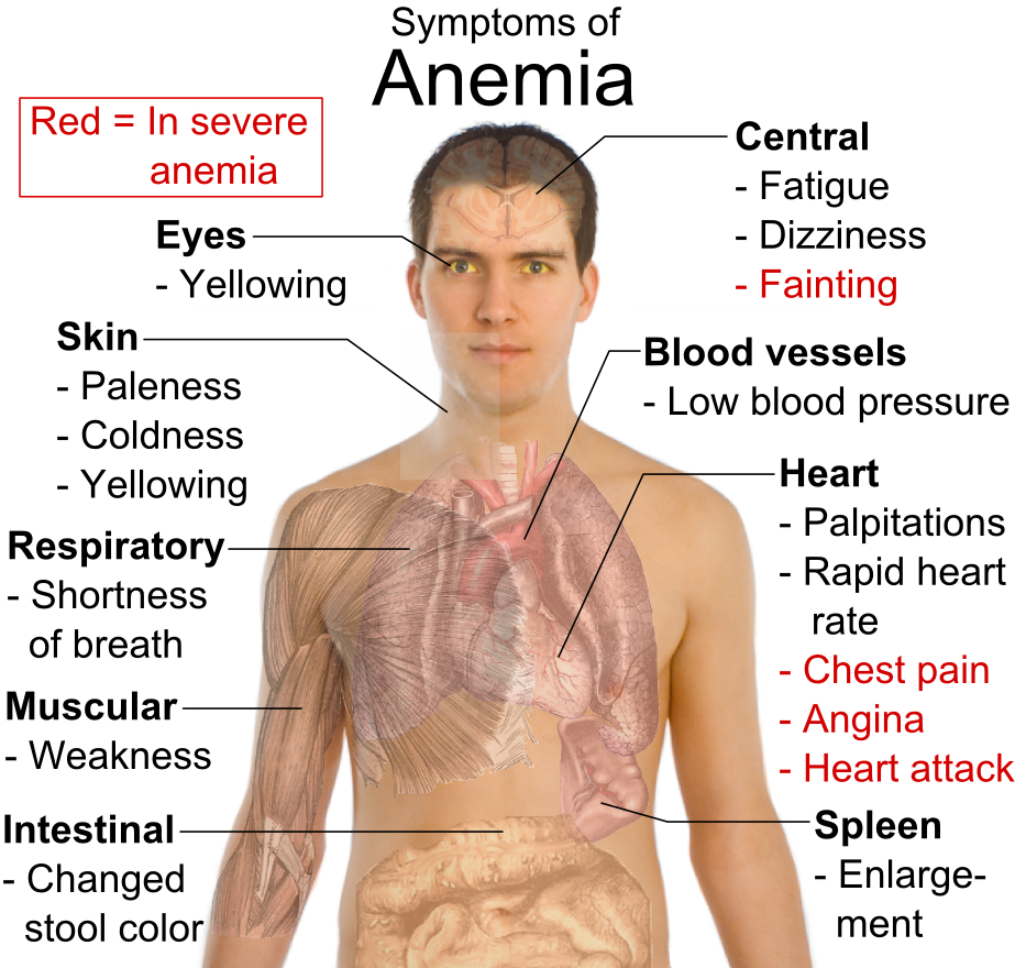 Rincón de la enfermería Anemia crónica refractaria (caso clinico)