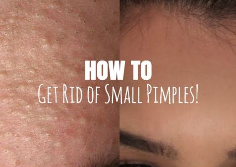 What Should You Do For Small Tiny Pimples On Face