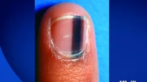 Si vous avez une tache noire sous votre ongle comme ça, Consultez un médecin immédiatement. Voici pourquoi.