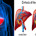12 Early Major Symptoms Of Having Problems In Your Liver