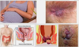 obat salep wasir luar bengkak di anus paling manjur di apotik