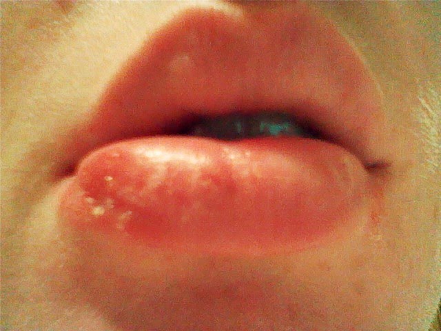 Herpes Pictures & Symptoms of Herpes Simplex