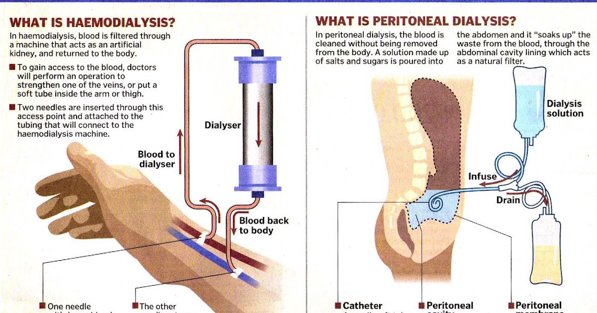 What is removed. Mechanism of Dialysis.