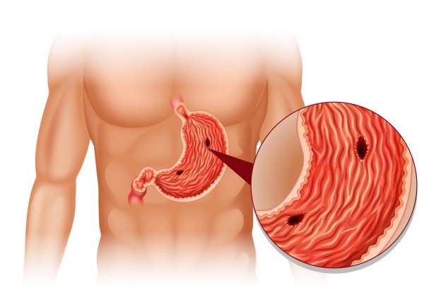 Stomach Ulcer Signs In Hindi
