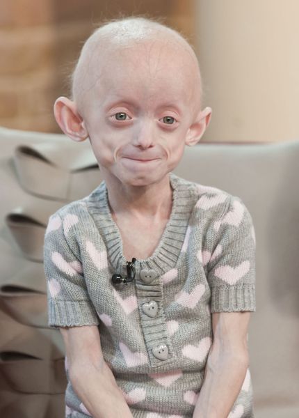 ශරීරයෙන් වයසට යාම රෝගය 😲😓 (Progeria) - Your Choice Way
