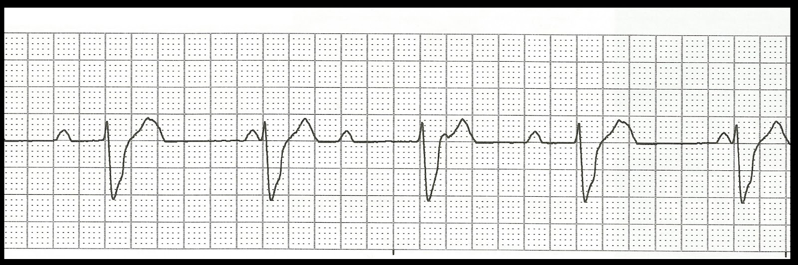 Heart Block Types Ecg