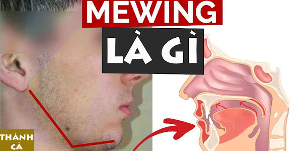 Mewing là gì?